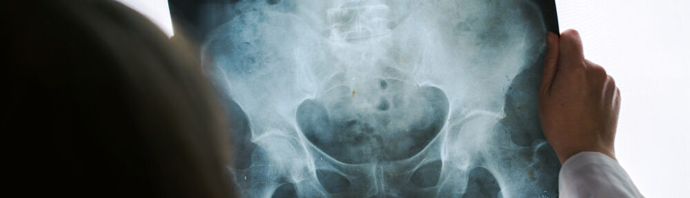 Pelvic Injury Lawyers Indianapolis Indiana 317-881-2700