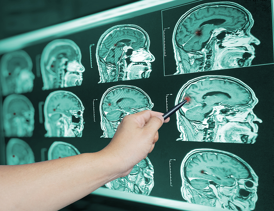TBI Accident Lawyers Indianapolis Indiana 317-881-2700