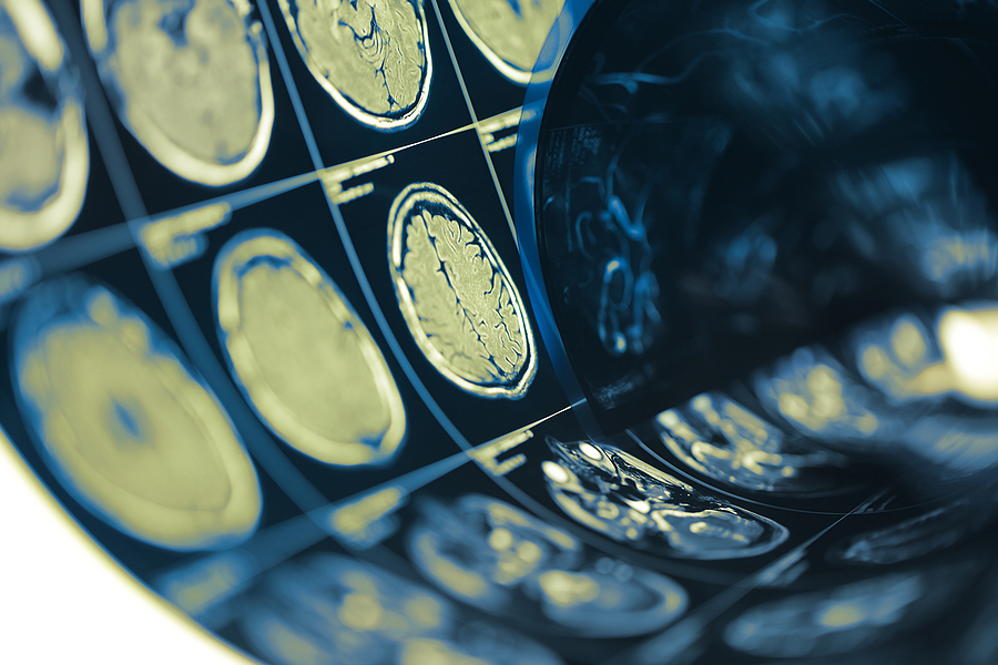 Brain Injury Attorneys Indianapolis Indiana