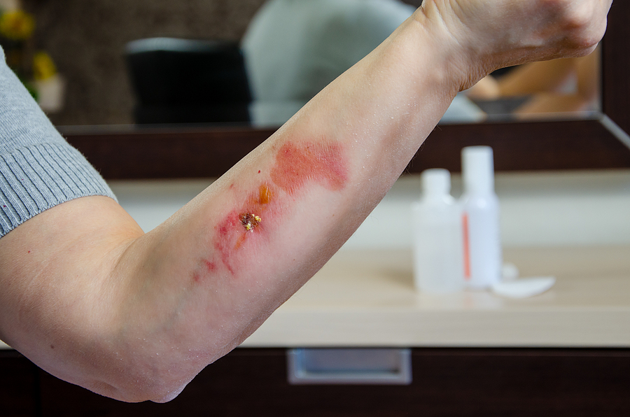 Call 317-881-2700 to Speak With a Burn Injury Attorney in Indianapolis Indiana